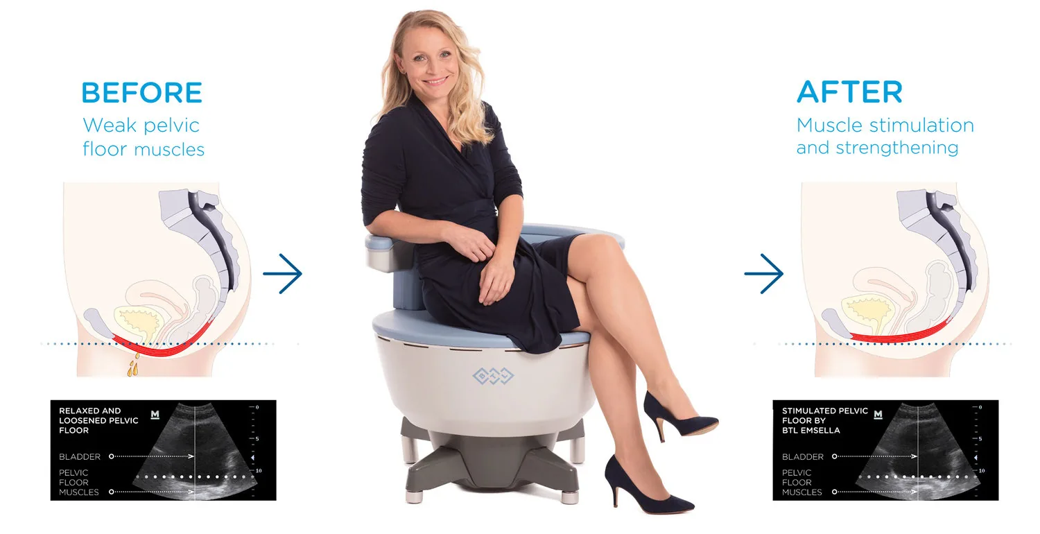 Illustration of the pelvic floor muscles beside a woman seated on the Emsella chair